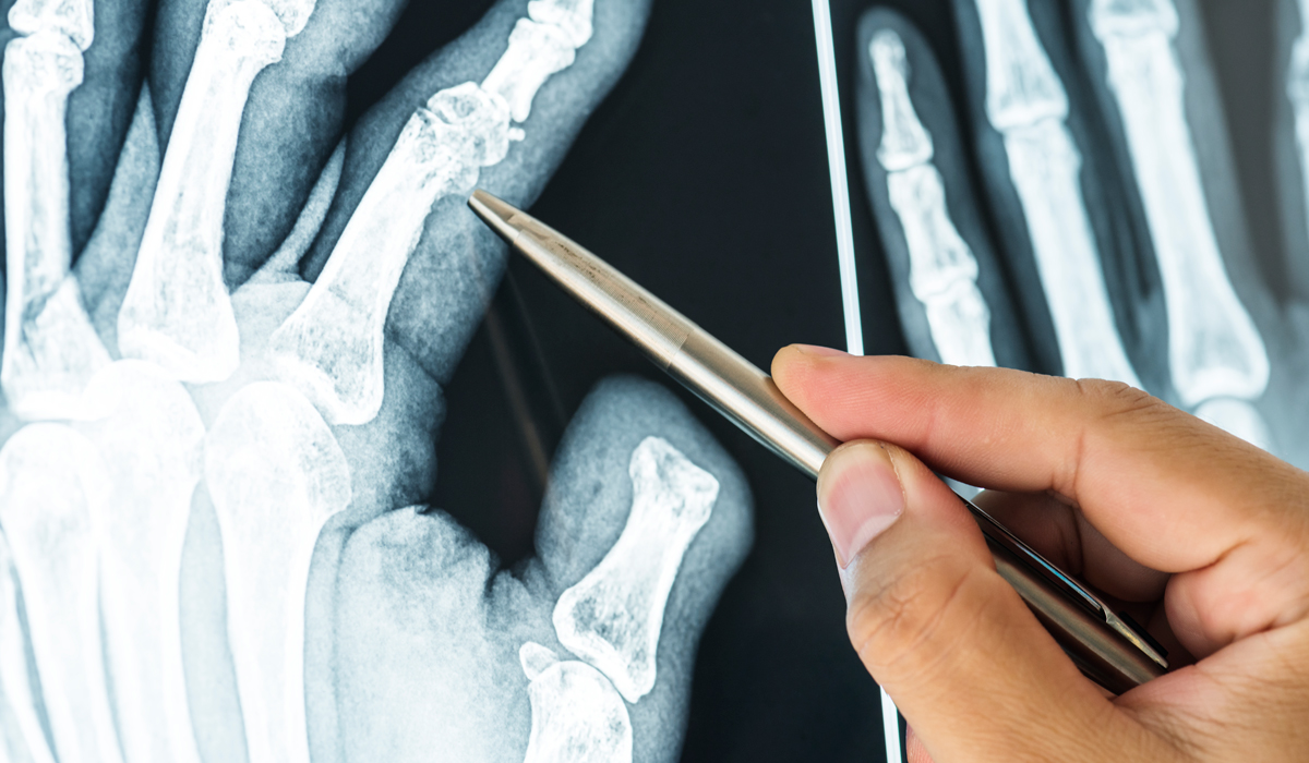 Brightly-Biomarkers-closeup-x-ray-film-fractured-finger